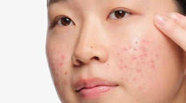 How to Get Rid of Acne: A Complete Guide for Clearer Skin