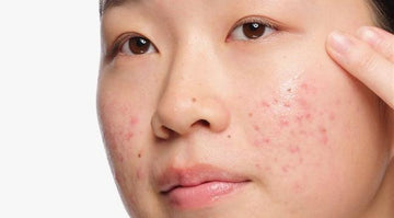 How to Get Rid of Acne: A Complete Guide for Clearer Skin